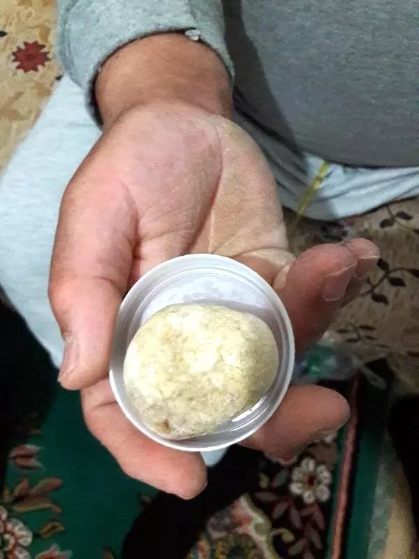 Mesanesinden 300 Gram Ağırlığında Taş Çıktı