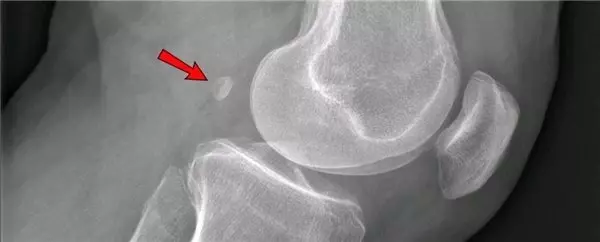 İnsan Anatomisinde Alışılmışın Dışında Gelişen 5 Farklı Özellik