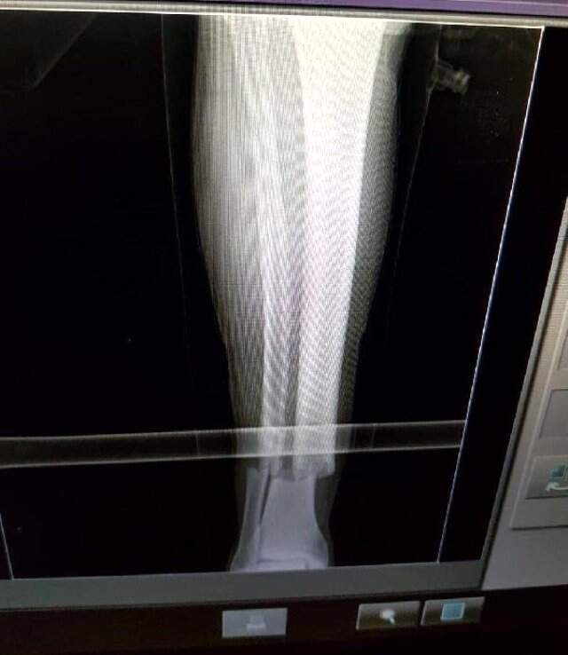 Rizespor Maçında Sakatlanan Emre Akbaba Yarın Ameliyat Edilecek