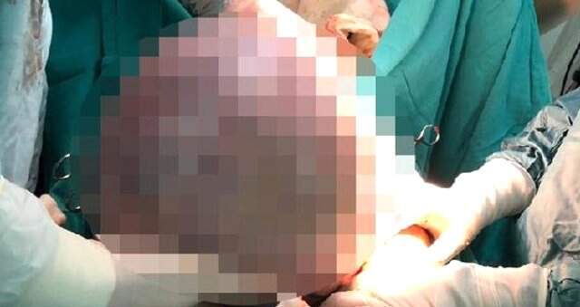 Solunum şikayetiyle doktora gitti! Karnından çıkan, doktorları bile hayrete düşürdü Solunum şikayetiyle doktora gitti! Karnından çıkan, doktorları bile hayrete düşürdü
