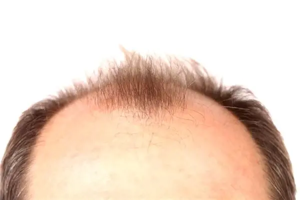 Bilim İnsanları, Kellik Sorununu Kökten Çözecek Bir Tedavi Geliştiriyor