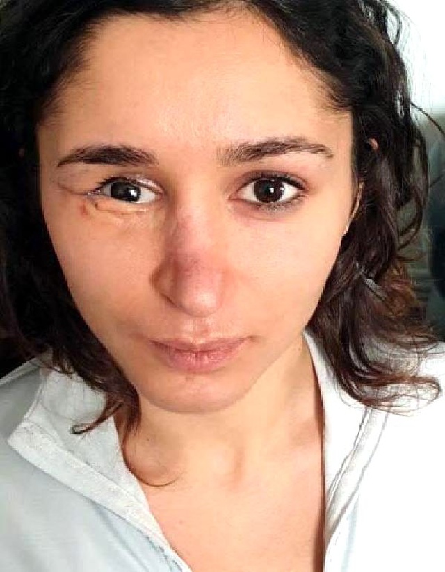 Sevgiliyken yüzünü parçalayan adamla evlenen Tuğçe,