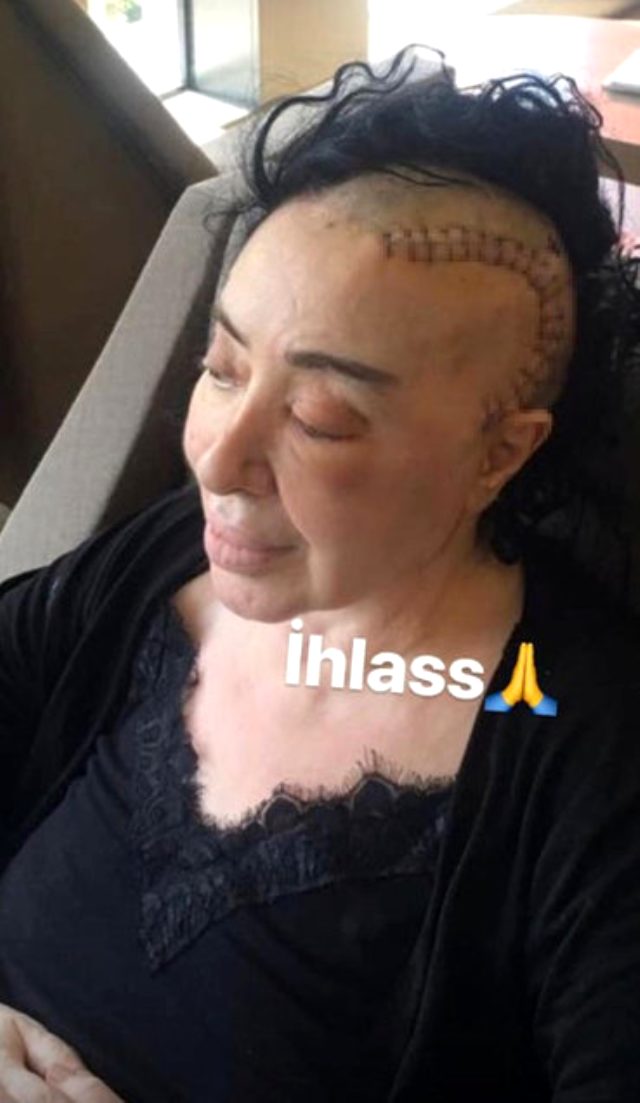 Beyin kanseriyle mücadele eden modacı Nur Yerlitaş, son haliyle korkuttu
