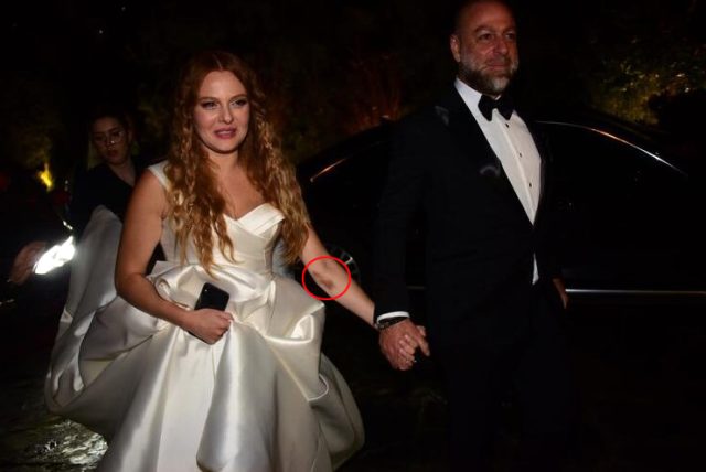 Dün akşam evlenen oyuncu Naz Elmas'ın kolundaki morluklar dikkat çekti