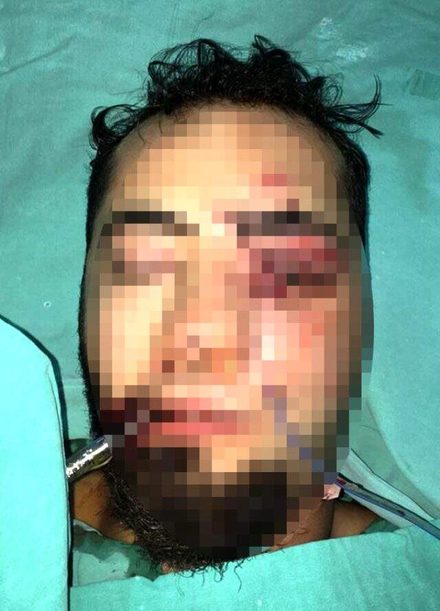 Yüzüne demir saplanan Emre, yoğun bakımdan çıktı