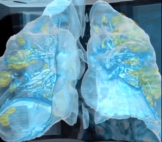 Koronavirüsün akciğerlere verdiği zarar sanal gerçeklik videosu ile gözler önüne serildi