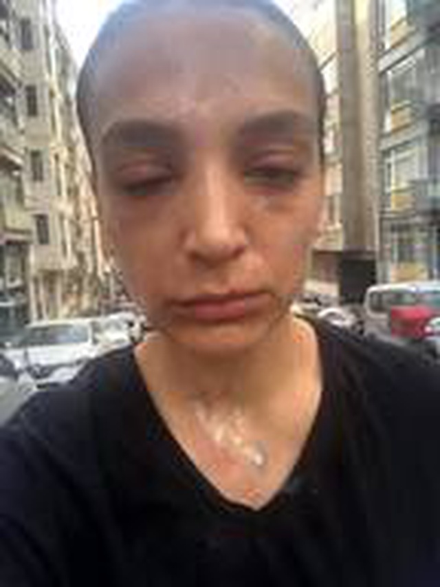 Lavabo açıcı bomba gibi patladı! Kadının yüzünde 2'inci derece yanıklar oluştu Lavabo açıcı bomba gibi patladı! Kadının yüzünde 2'inci derece yanıklar oluştu