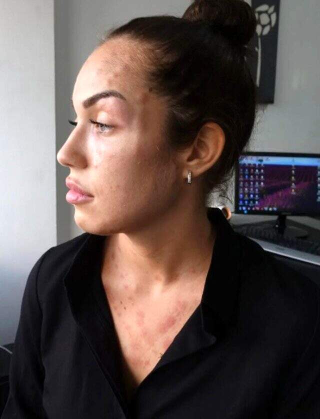 'Gençlik aşısı' adı altında cildine işlem yapılan genç kadının hayatı karardı 'Gençlik aşısı' adı altında cildine işlem yapılan genç kadının hayatı karardı