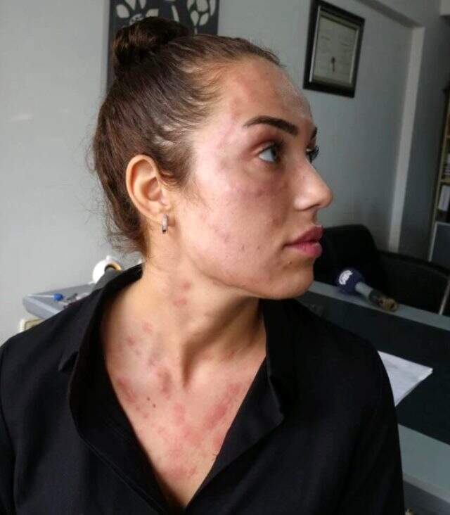 'Gençlik aşısı' adı altında cildine işlem yapılan genç kadının hayatı karardı 'Gençlik aşısı' adı altında cildine işlem yapılan genç kadının hayatı karardı
