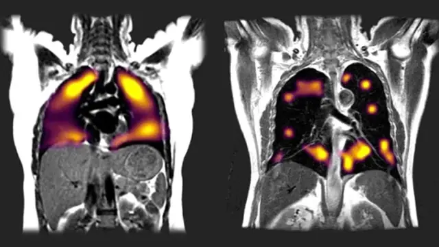 Covid-19: Yeni tarama tekniği, akciğerlerdeki hasarı 'gösterdi'