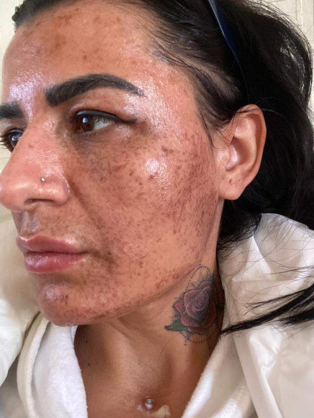 İnternetten önüne çıkan güzellik salonu ilanı kadının yüzünü yaktı, şimdi aylarca tedavi olmak zorunda İnternetten önüne çıkan güzellik salonu ilanı kadının yüzünü yaktı, şimdi aylarca tedavi olmak zorunda