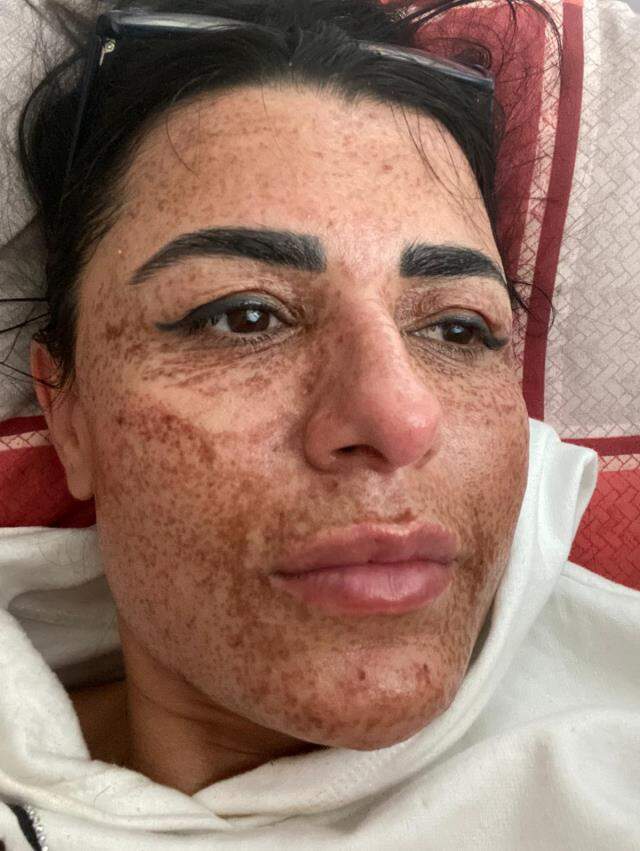 İnternetten önüne çıkan güzellik salonu ilanı kadının yüzünü yaktı, şimdi aylarca tedavi olmak zorunda İnternetten önüne çıkan güzellik salonu ilanı kadının yüzünü yaktı, şimdi aylarca tedavi olmak zorunda