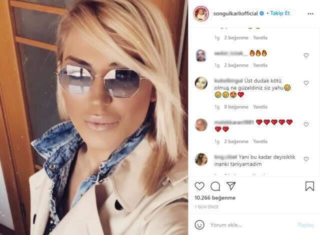 'Çocuğumla bir ekmeğe muhtaç kaldım' diyen Songül Karlı dudaklarına dolgu yaptırdı