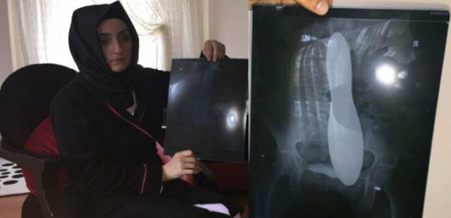 Kadının karnında unutulan mala için hastane 82 bin lira tazminat ödeyecek