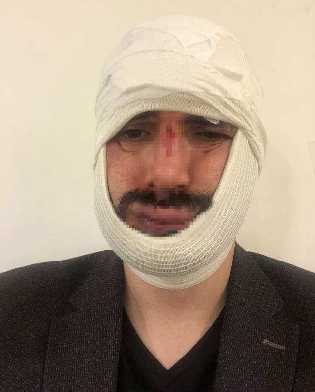 Motosikletli magandalardan muhabire öldüresiye dayak! Çenesi kırıldı, yüzüne onlarca dikiş atıldı