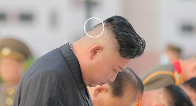 Kuzey Kore lideri Kim Jong-un kafasının arkası çürüdü
