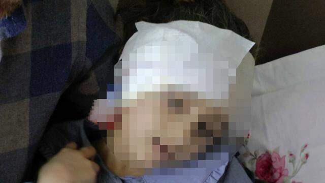 Bir anda üzerine koşan köpek, kızın kulağını kopardı Bir anda üzerine koşan köpek, kızın kulağını kopardı
