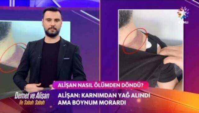 Yağ aldırma ameliyatında ölümden dönen Alişan'dan doktora rekor tazminat davası