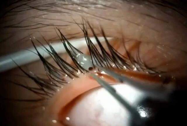 Tıp dünyasını şaşkına çeviren olay! Genç kızın gözünün içine kene girdi doktor bile çıkaramadı Tıp dünyasını şaşkına çeviren olay! Genç kızın gözünün içine kene girdi doktor bile çıkaramadı