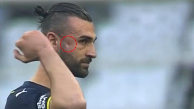 Elmacık kemiğine darbe alan Fenerbahçe'nin forveti Serdar Dursun ameliyat oldu Elmacık kemiğine darbe alan Fenerbahçe'nin forveti Serdar Dursun ameliyat oldu
