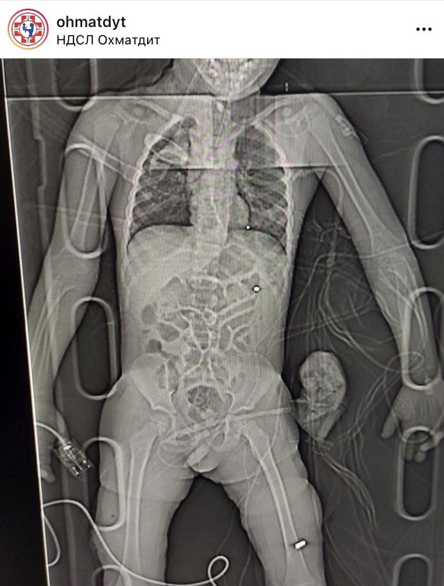 Savaşın korkunç yüzü! Rus bombalarıyla ağır yaralanan çocuğun fotoğrafları yürek parçaladı Savaşın korkunç yüzü! Rus bombalarıyla ağır yaralanan çocuğun fotoğrafları yürek parçaladı