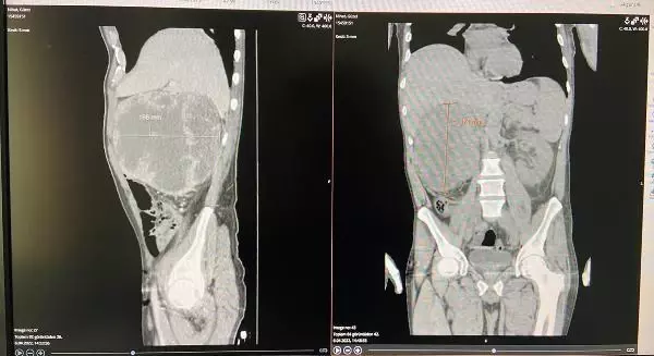 Halsizlik şikayetiyle gitti, karnından 20 santimlik kitle çıkarıldı
