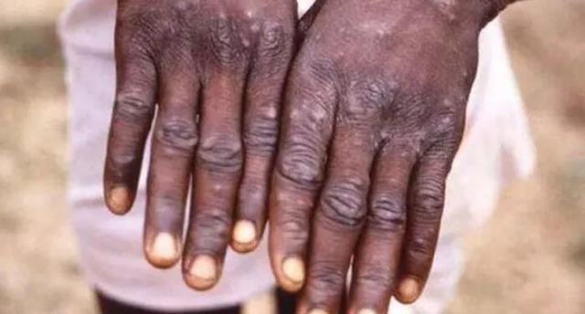 Dünya diken üstüned! Maymun çiçeği virüsü İtalya ve İsveç'e de sıçradı