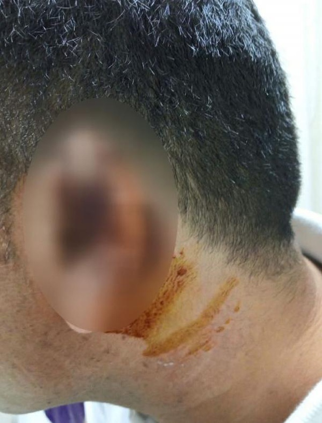Kavgada ısırılarak koparılan kulağını martı kaptı