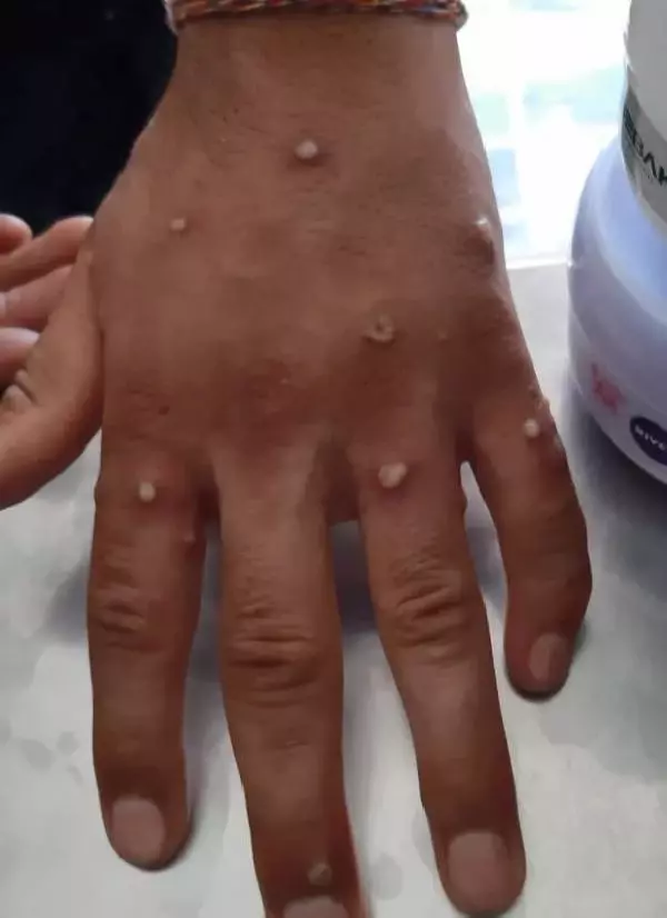 İstanbul'da maymun çiçeği alarmı! Ellerinde yaralar çıkan 2 kişi ekipler tarafından alındı, test sonuçları bekleniyor