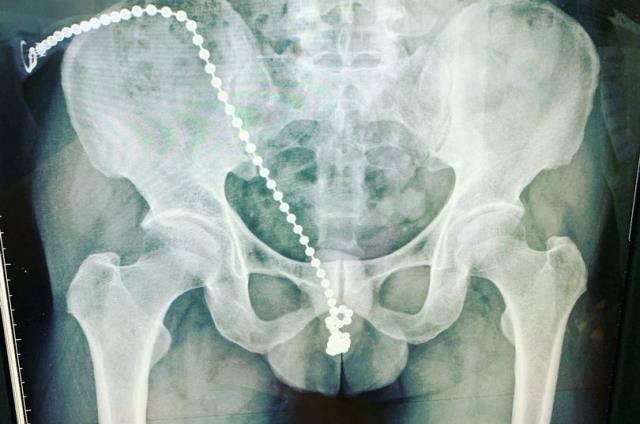 Mastürbasyon yaptığı sırada cinsel organına zincir sokan adam ölümden döndü Mastürbasyon yaptığı sırada cinsel organına zincir sokan adam ölümden döndü