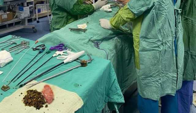 Doktor, güçlükle ikna ettiği hastanın safra kesesinden 2 bin adet taş çıkardı Doktor, güçlükle ikna ettiği hastanın safra kesesinden 2 bin adet taş çıkardı
