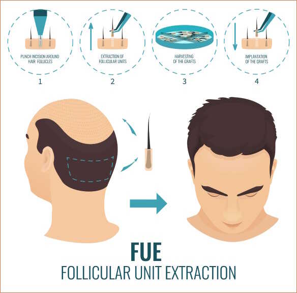 What is a FUE Hair Transplant? Is FUE Hair Transplant Permanent? Hair Transplant Before and After İstanbul, Türkiye What is a FUE Hair Transplant? Is FUE Hair Transplant Permanent? Hair Transplant Before and After İstanbul, Türkiye