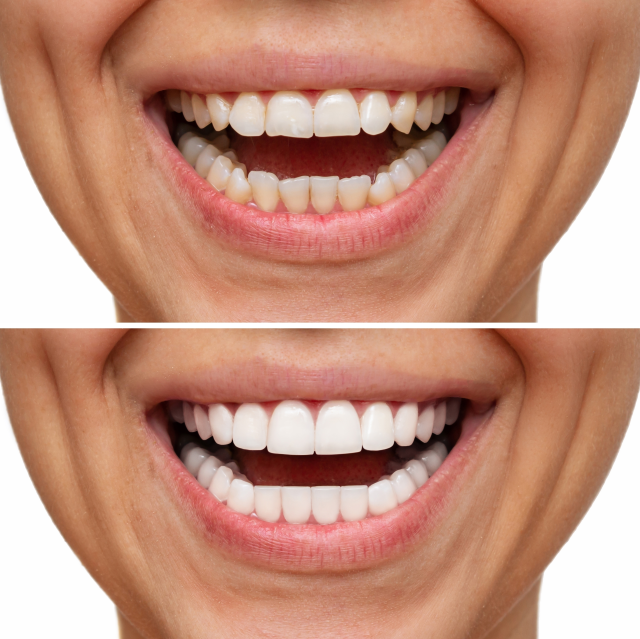 What is the Hollywood smile method? How much is a Hollywood smile in İstanbul, Turkey?