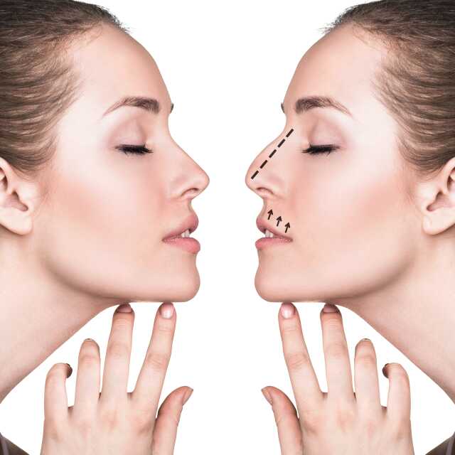 How much is a septorhinoplasty in Türkiye? Achieve Improved Nasal Function and Aesthetic Harmony with Septorhinoplasty How much is a septorhinoplasty in Türkiye? Achieve Improved Nasal Function and Aesthetic Harmony with Septorhinoplasty