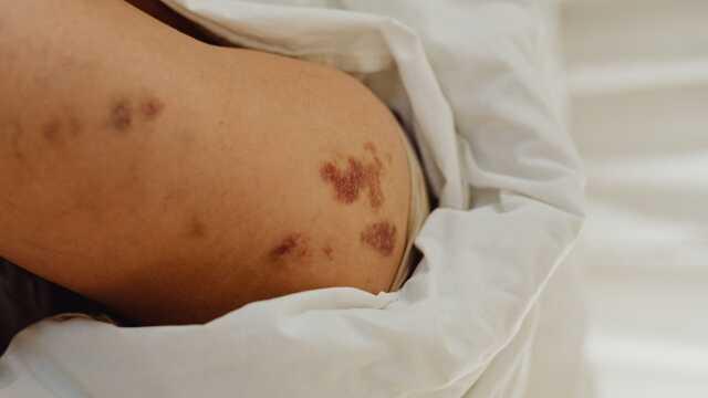 Doğum lekesi neden olur? Doğum lekelerinin türleri ve tedavi yöntemleri