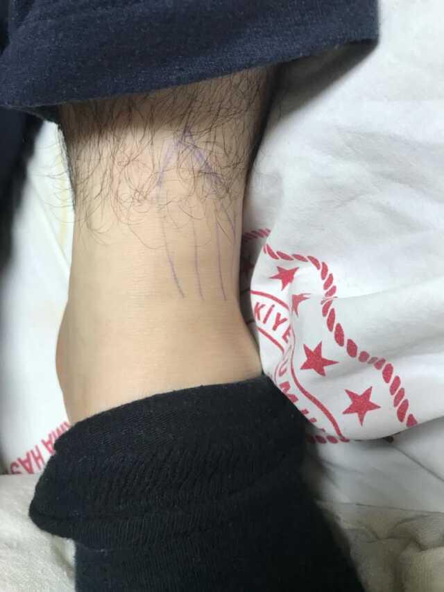 Operasyondan çıkan hasta kendine gelince hayatının şokunu yaşadı: Yanlış ayağımı ameliyat ettiler