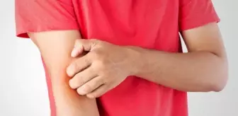 İsilik neden olur, nasıl geçer? İsilik kaşınır mı, bulaşıcı mı? Belirtileri ve tedavisi