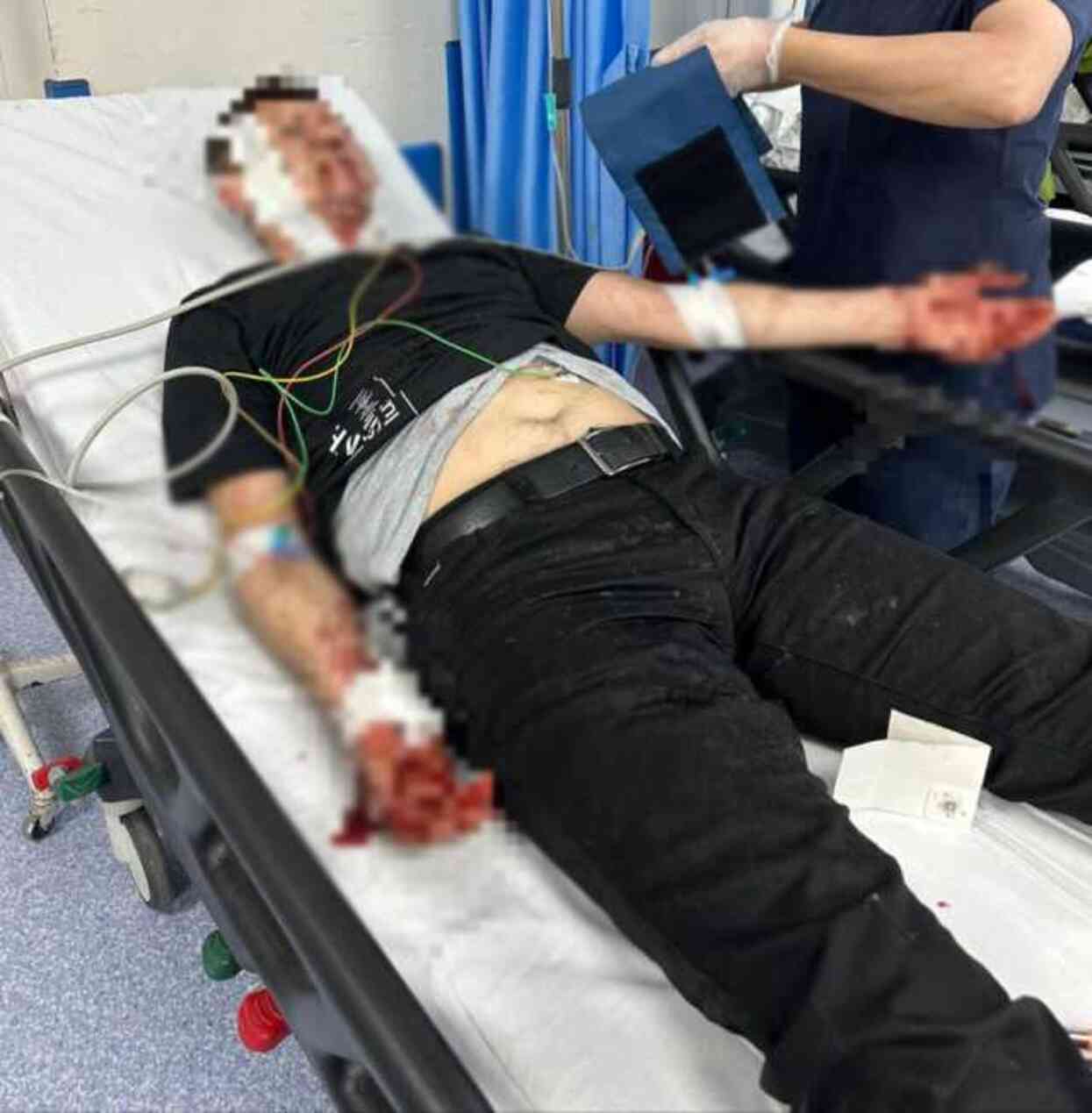 Bursa'da başıboş köpek dehşeti! Çenesi kırılan, kulağına 30 dikiş atılan baba 1,5 ay pipetle beslenecek Bursa'da başıboş köpek dehşeti! Çenesi kırılan, kulağına 30 dikiş atılan baba 1,5 ay pipetle beslenecek