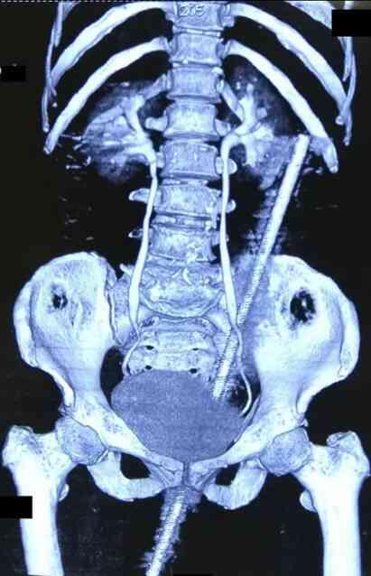 Yaşlı kadın, tarlada çalıştığı sırada 60 cm uzunluğundaki paslı metal çubuğa saplandı