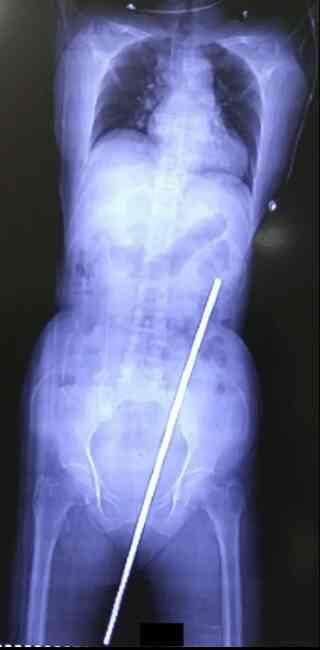 Yaşlı kadın, tarlada çalıştığı sırada 60 cm uzunluğundaki paslı metal çubuğa saplandı