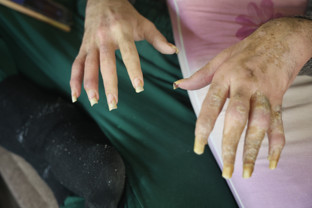 3 yıldır tırnaklarını kesmeyen ve duş almayan gencin eski hali ortaya çıktı 3 yıldır tırnaklarını kesmeyen ve duş almayan gencin eski hali ortaya çıktı