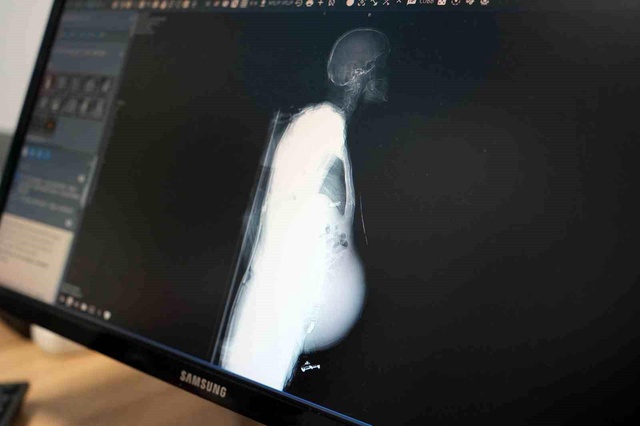 Halsizlik şikayetiyle hastaneye gitti, karnından 6,5 kilogramlık tümör çıktı