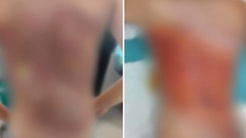 Arnavutköyde akran zorbalığı iddiası: 12 yaşındaki çocuğun sırtını kolonya ile yaktılar