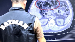 Şüpheli hareketleri ele verdi! Midesinden çıkanlar şaşkına çevirdi
