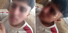 İddia vahim Öğretmenin kafa attığı çocuğun burnu kırıldı
