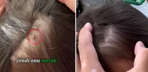 Baba, kızının kafasına yapışan keneyi böyle kopardı