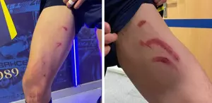 Edson Alvarez’in bacağının son hali inanılmaz