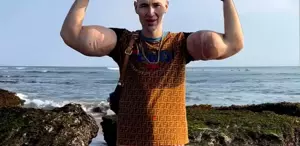 Rus Temel Reis’in kolları tehlikede: Tehlikeli enjeksiyonlar ağır enfeksiyona yol açtı