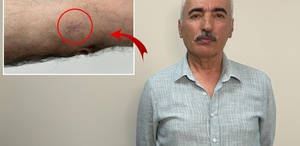 Kolundaki 1 santimetrelik yara kanser çıktı