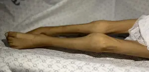 Gazze Şeridi’nde bir çocuk daha “açlıktan“ öldü 3 kiloya kadar düşmüştü